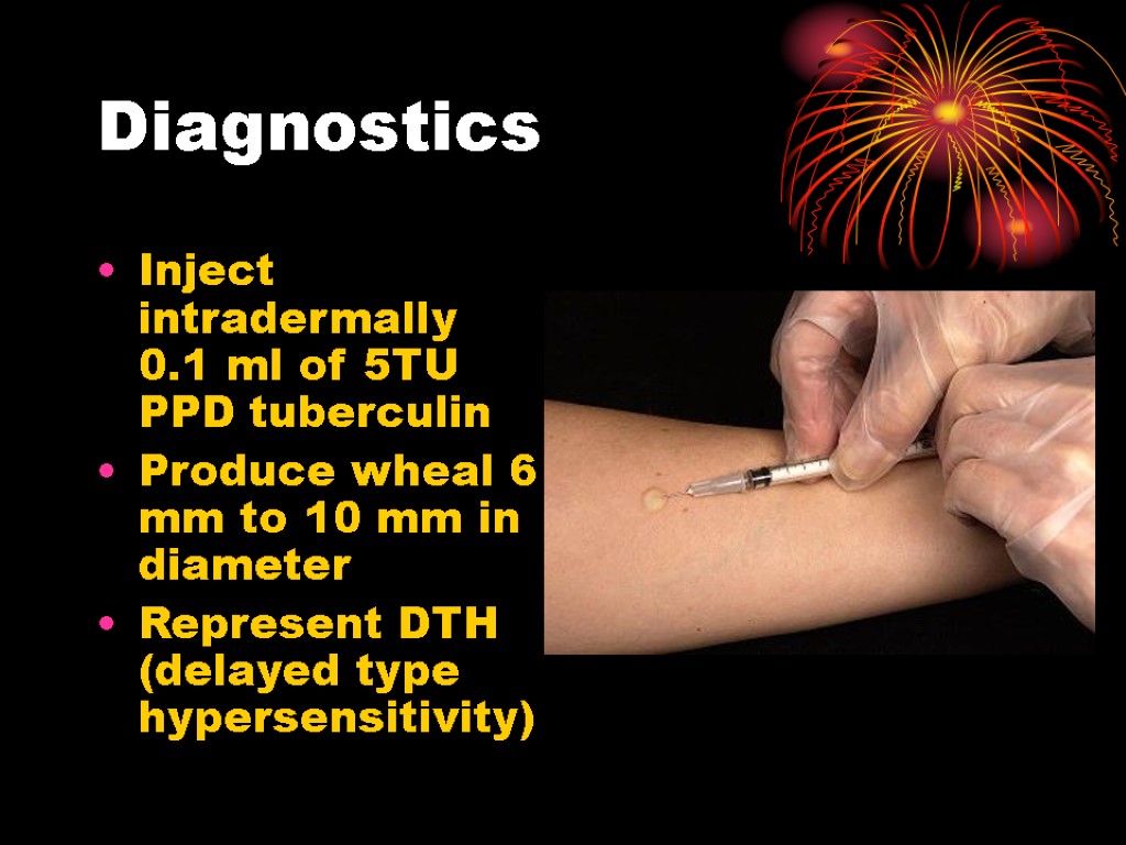 Diagnostics Inject intradermally 0.1 ml of 5TU PPD tuberculin Produce wheal 6 mm to
